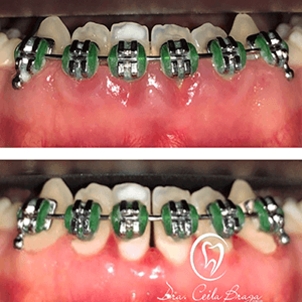 Gengivoplastia