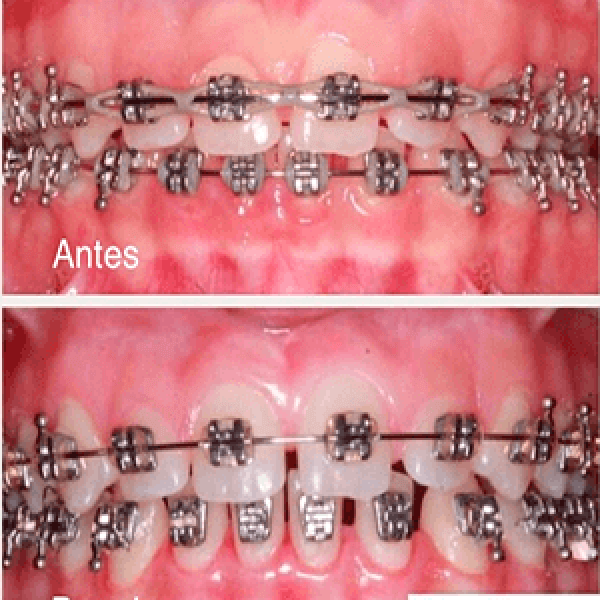 Gengivoplastia