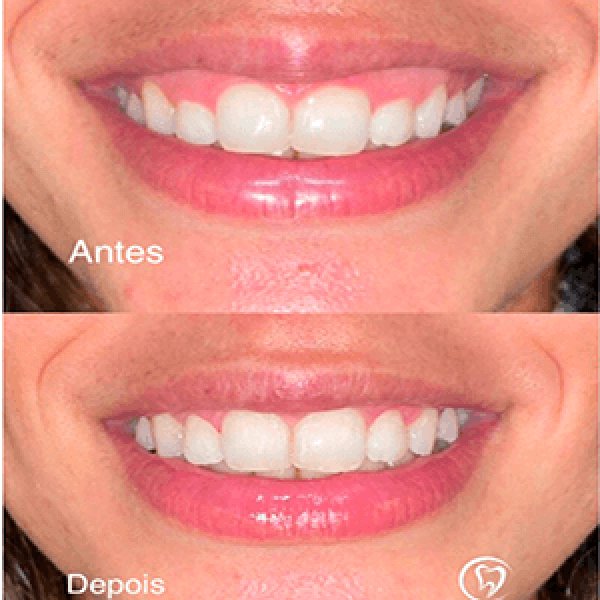 Gengivoplastia