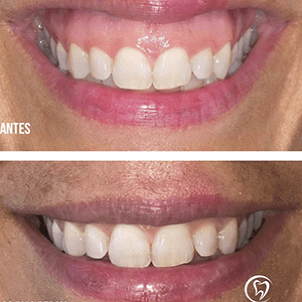 Gengivoplastia