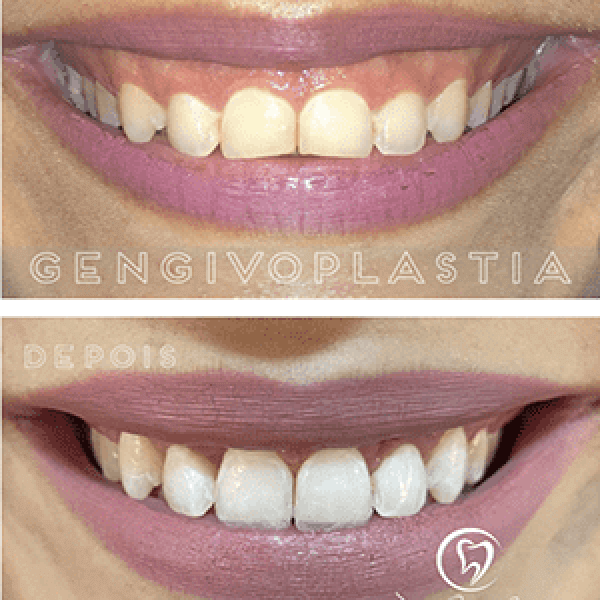 Gengivoplastia