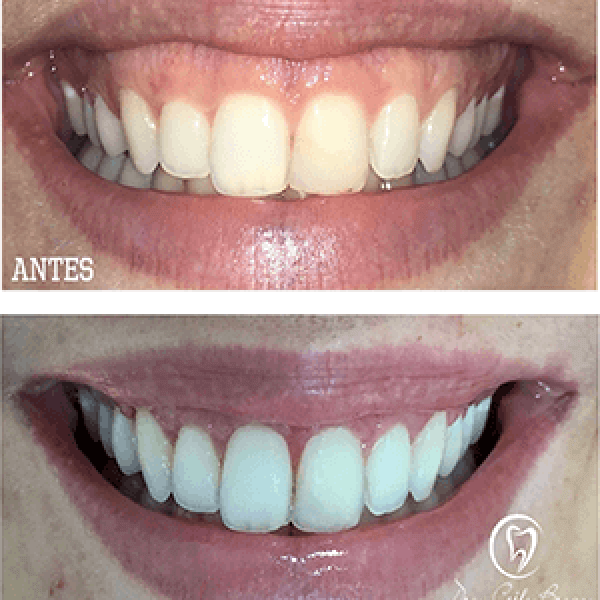 Gengivoplastia