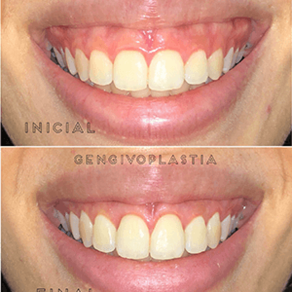 Gengivoplastia