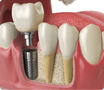 Implante Dentário implante