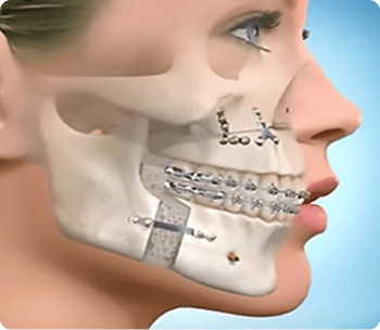 Bucomaxilofacial Bucomaxilofacial