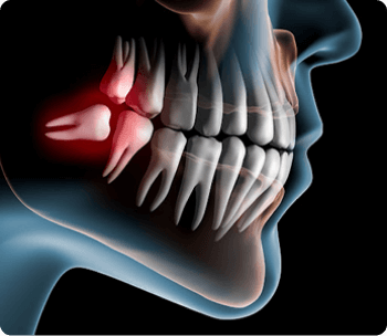 Cirugia Oral Menor Cirugia Oral Menor