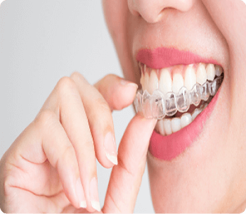 Aparelho Invisalign invisalign